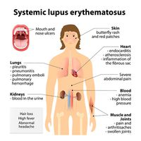 Lupus erythematosis