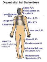 Sarcoidosis