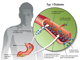 Diabetes mellitus Typ 1