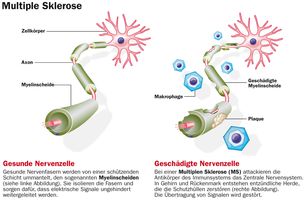 Multiple Sclerosis 