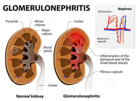 Glomerulonephritis