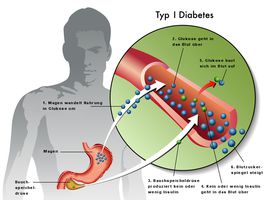 Diabetes mellitus Type 1 